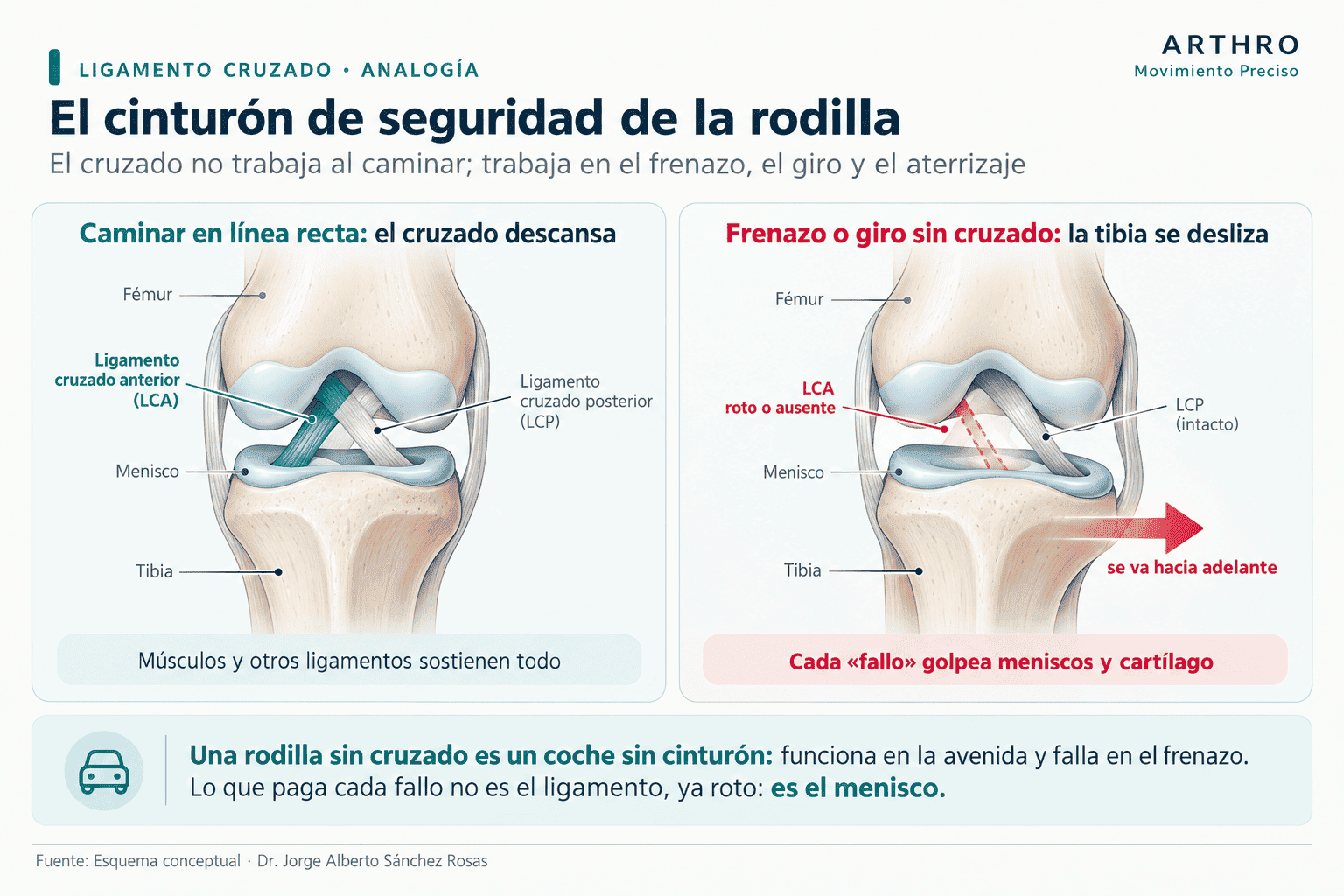 El LCA no trabaja al caminar; trabaja en el frenazo, el giro y el aterrizaje. Por eso una rodilla sin cruzado "se siente bien" hasta que se le exige.